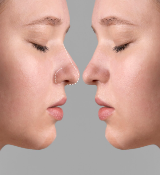 Burun Eti Küçültme - Onur Ergün