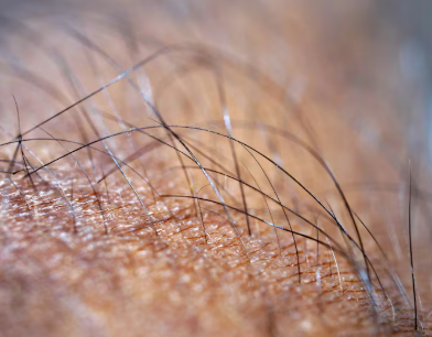 kil-donmesinde-tedavi-tipleri-ve-hizli-cerrahi-mikrosinusektomi-op-dr-sabahattin-destek