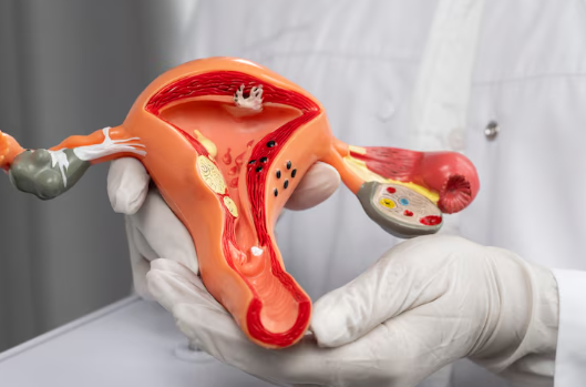 Histerektomi (Rahim Alınması) - Op. Dr. Sare Doğan