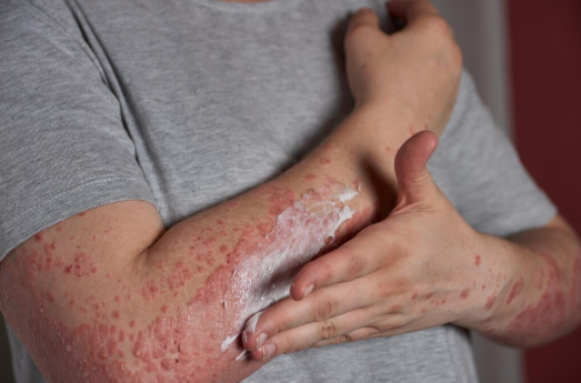 Egzema - Dr. Kübra Esen