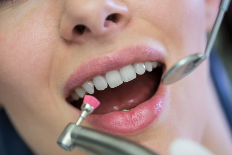 GBT (Guided Biofilm Therapy) Nedir? - Dt. Seyhun Türkozan