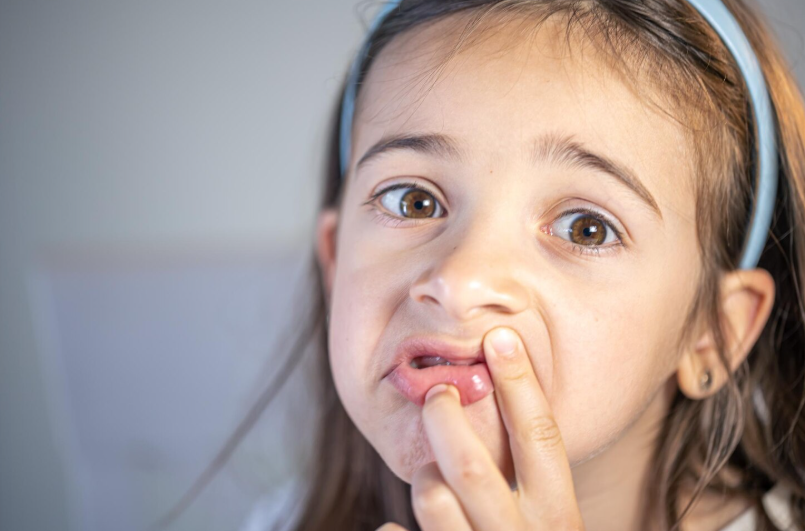Çocuklarda Labial Füzyon (Labial Yapışıklık) Nedir? Ne Zaman Tedavi Gerekir? - Op. Dr. Selim Özkaya
