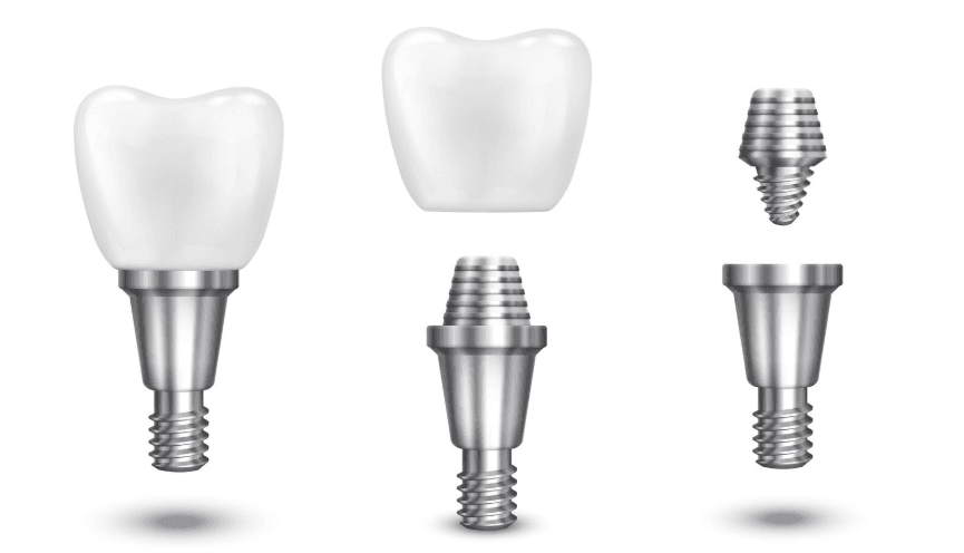 implant-tedavisi-oncesinde-bilmeniz-gerekenler-uygunluk-tedavi-suresi-ve-uzun-donem-bakim-dt-hakan-azap