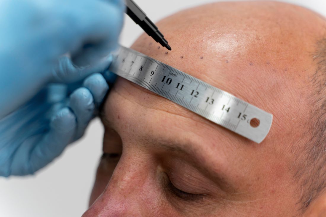 Micropigmentación capilar: qué es y para qué sirve