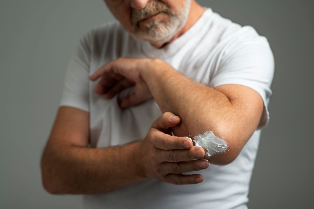 hombre barba poniendose crema codo psoriasis
