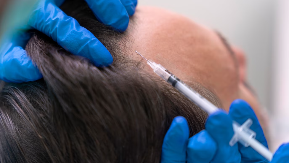 seringa de anestesia sendo aplicada no couro cabeludo