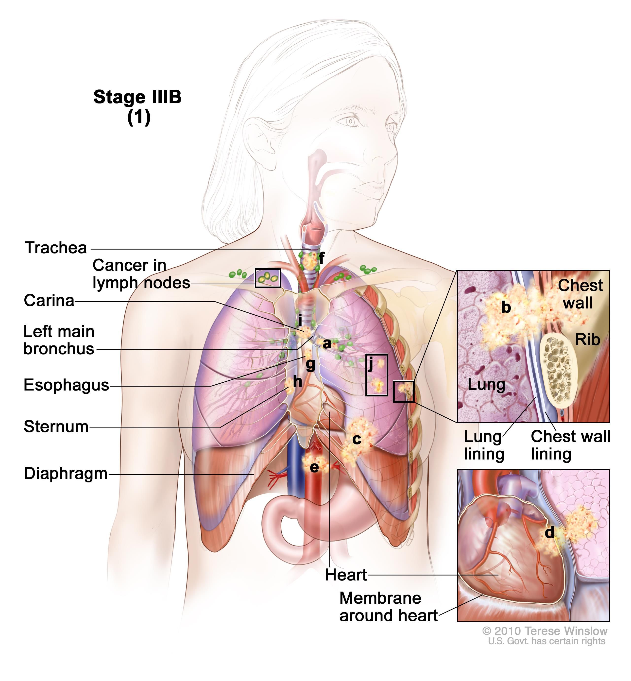 A New Treatment Strategy for Stage III Lung