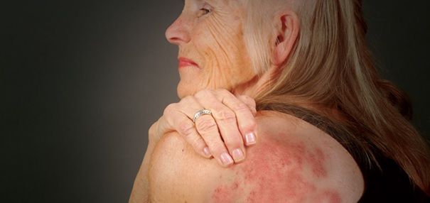 Ağrılı Bir Cilt Hastalığı: Zona