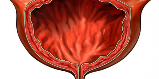 Ağrısız Kanama ve Mesane Kanseri
