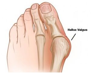 Ayak Başparmağının Şekil Bozukluğu: Halluks Valgus