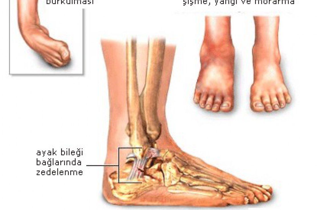 Ayak Bileği Burkulmaları