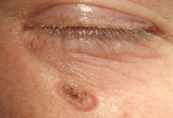 basalzellkarzinom-basaliom-hautkrebs-symptome