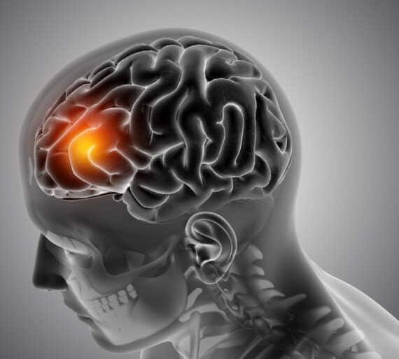 Beyin Tümörü Tedavi Seçenekleri