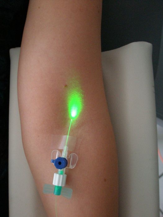 intravenoese-laser-therapie-was-ist-das-wie-funktionierts