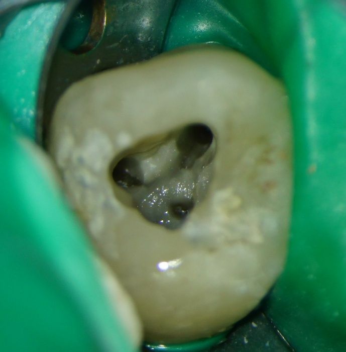 wurzelkanalbehandlung-mit-dentalmikroskop