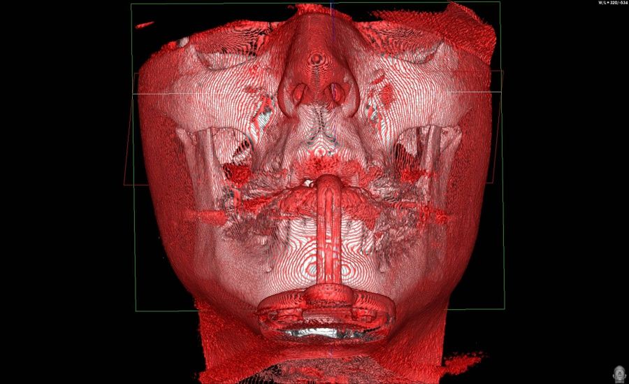 dvt-sicherheit-in-der-zahnaerztlichen-implantologie