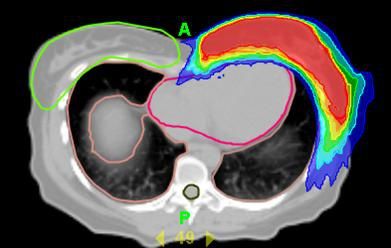 moderne-bestrahlungstechniken-mammakarzinom