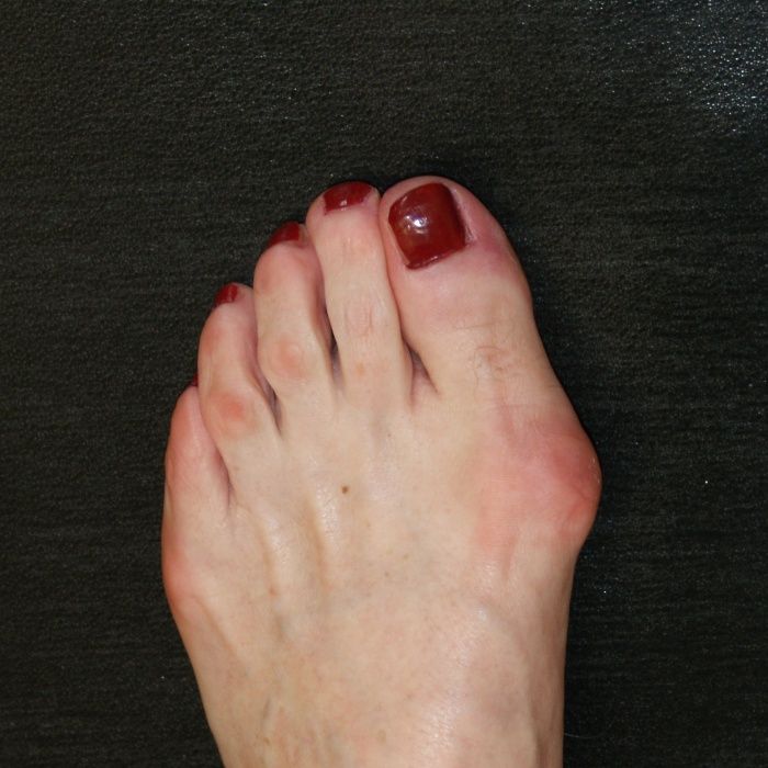 hallux-valgus-operationen-heute