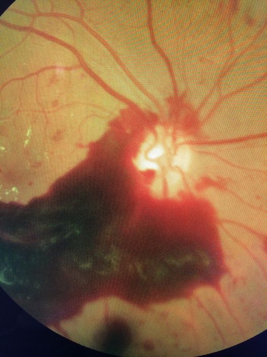 diabetische-netzhauterkrankung-teil-2
