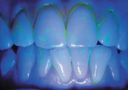 parodontitis-behandlung-mit-fluoreszenzmarkern