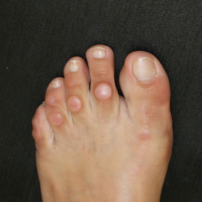 hammerzehen-krallenzehen