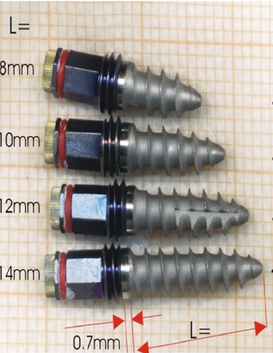 implantate-beim-zahnarzt