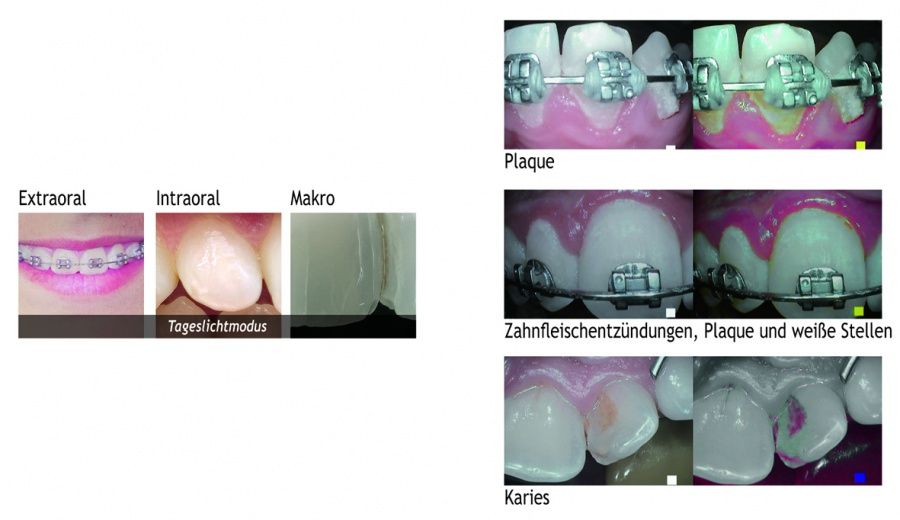 zahnhygiene-zahnspange