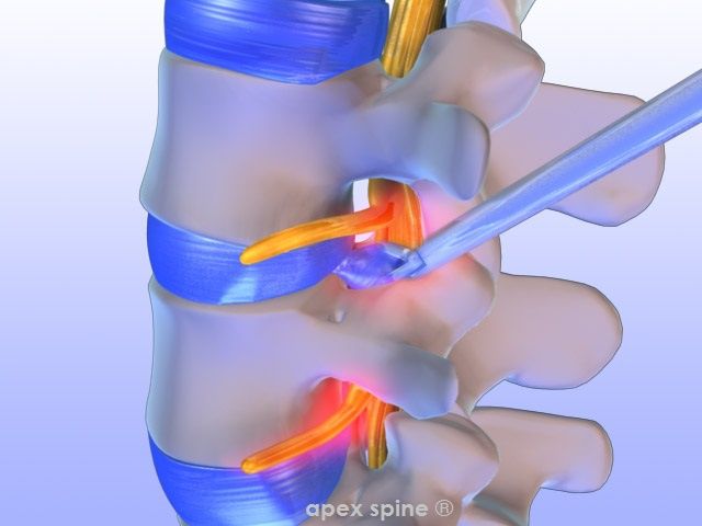 die-endoskopische-bandscheiben-op