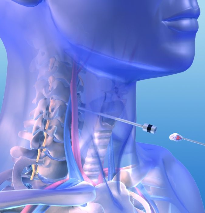 bandscheibenvorfall-halswirbelsaeule-minimalinvasive-op