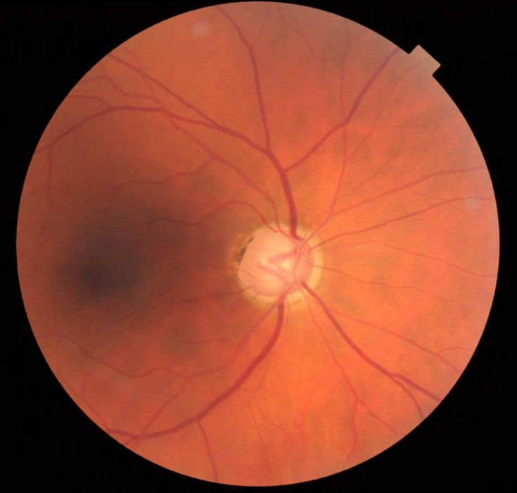 warum-glaukomvorsorge