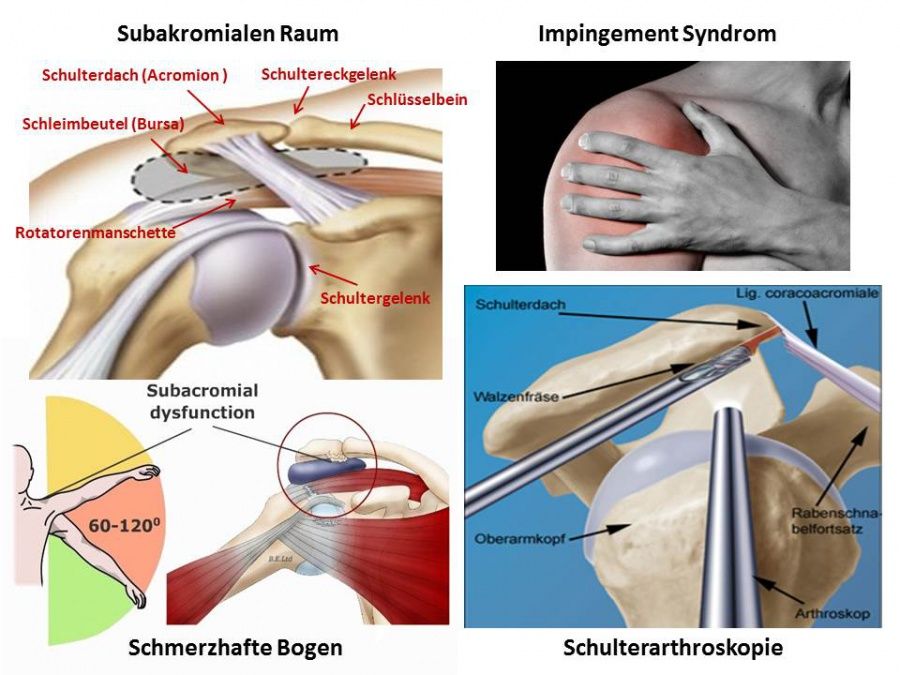 impingement-syndrom-rotatorenmanschettenriss-teil-2