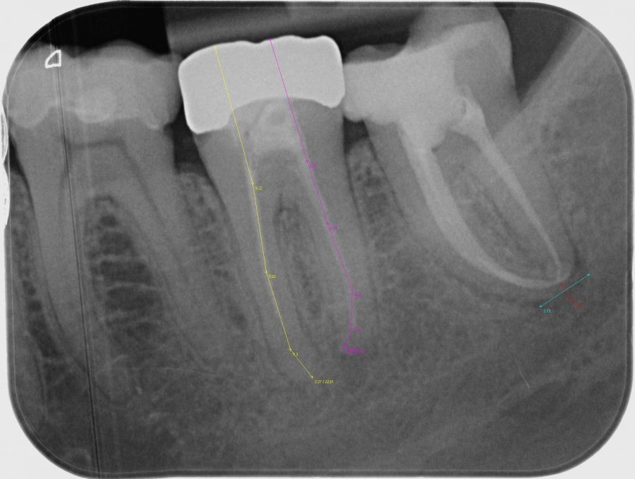 wurzelkanalbehandlung-was-ist-das