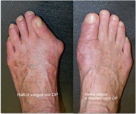 die-light-op-bei-hallux-valgus