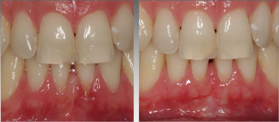 freiliegende-zahnhaelse-behandlung