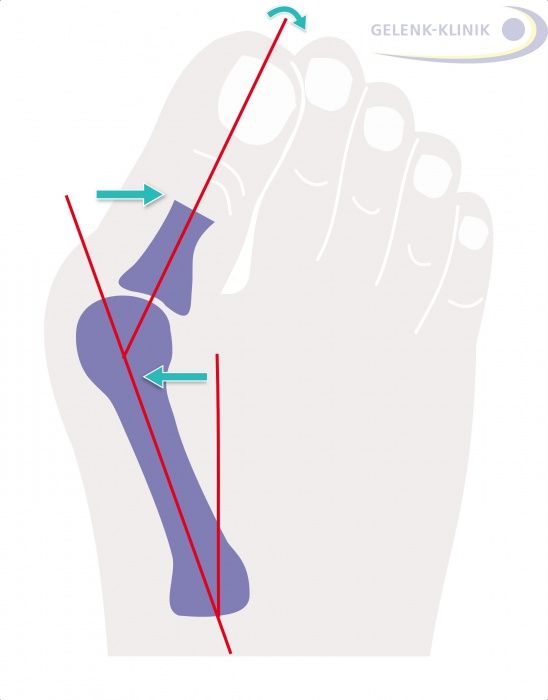 hallux-valgus-therapieren-und-minimalinvasiv-operieren