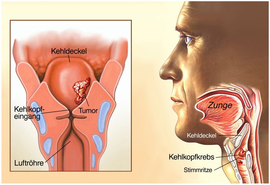 kehlkopfkrebs-wissenswertes-zu-ursachen-symptome-diagnose-und-behandlung