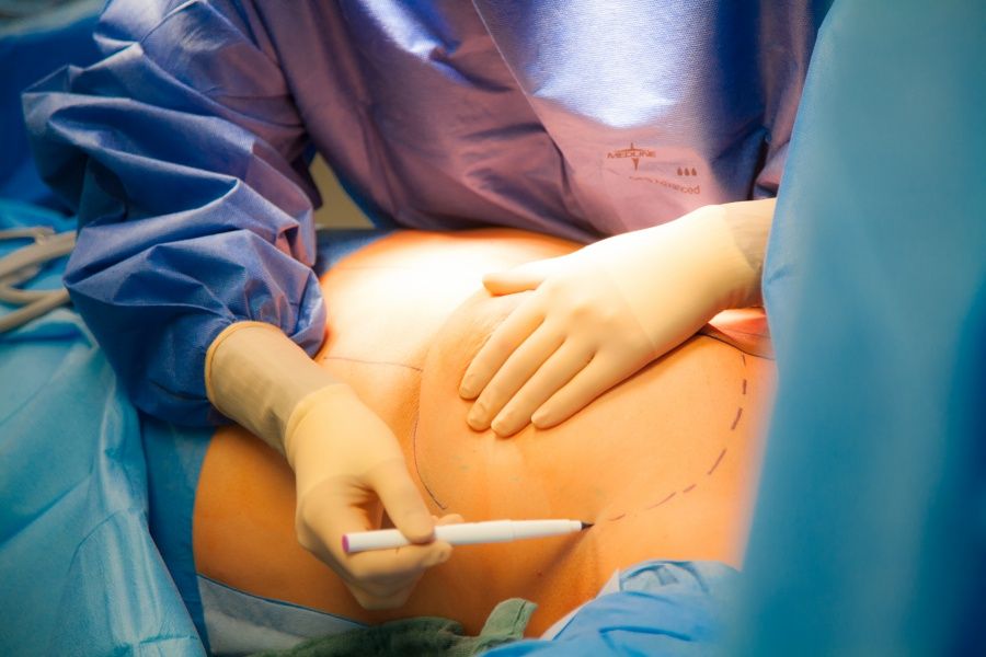 brustverkleinerung-auf-koerbchen-a-wann-ist-es-moeglich