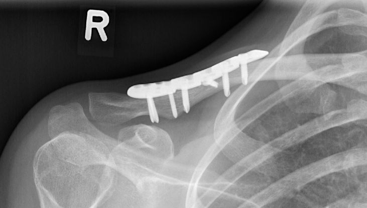 schluesselbeinbruch-operieren-oder-nicht