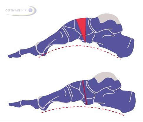 was-ist-ein-hohlfuss-und-wie-kann-er-behandelt-werden