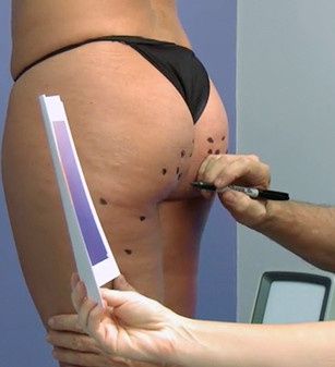 cellulite-mit-cellfina-dauerhaft-behandeln-so-gehts