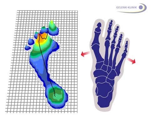 was-ist-ein-spreizfuss-alles-ueber-ursachen-behandlung