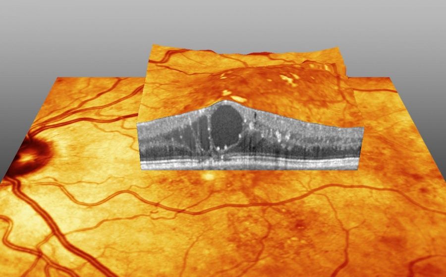 Behandlung & Verlauf der chronischen Erkrankungen AMD & DMÖ