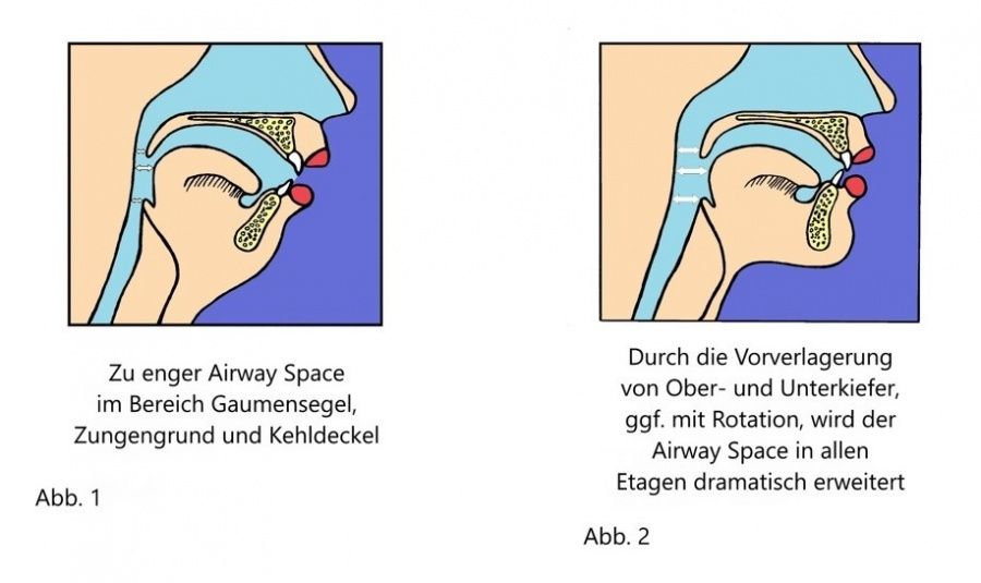 ist-schlafapnoe-heilbar