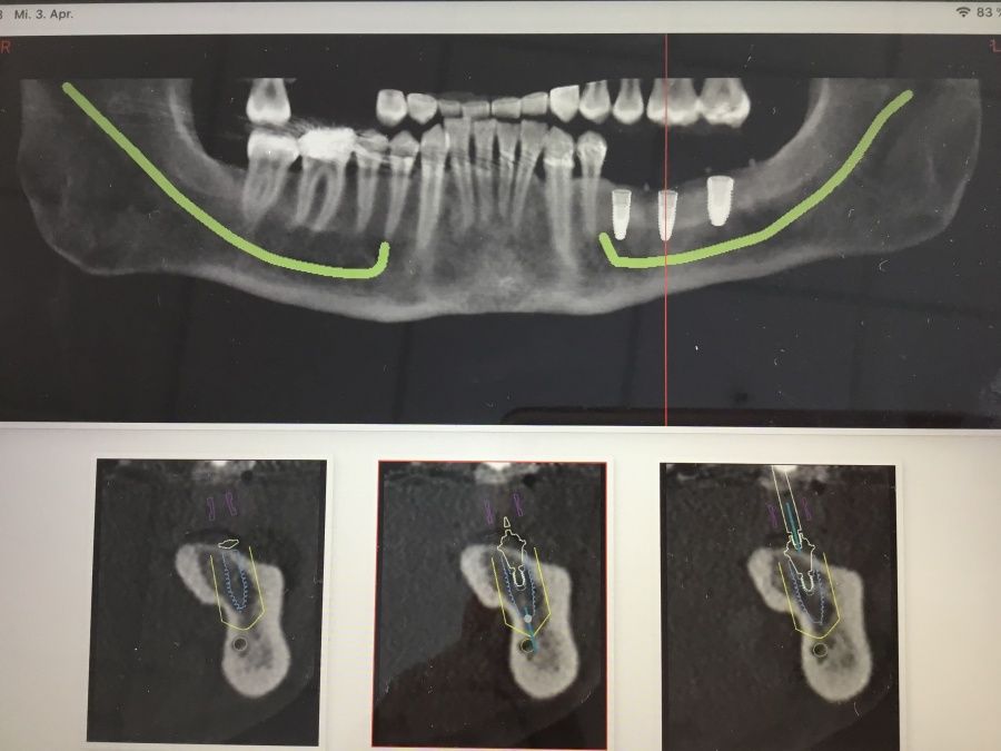 Mehr Freude am Lachen: Hochwertige Zahnimplantate durch präzise 3D-Planung