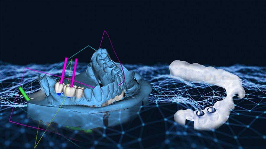 3d-navigierte-zahnimplantate-mehr-praezision-ohne-skalpell