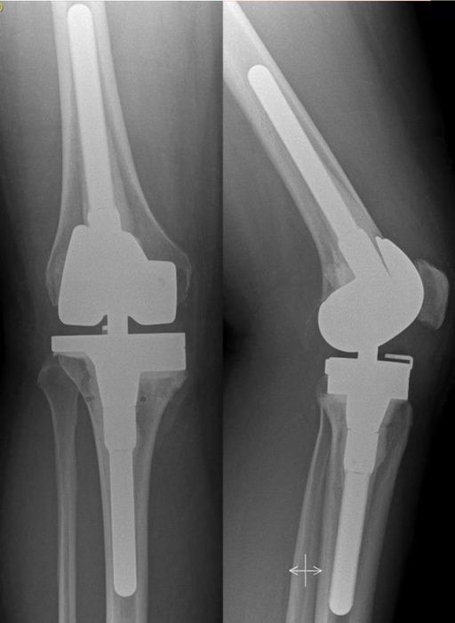 schmerzen-kniekunstgelenk-symptome-ursache-therapi