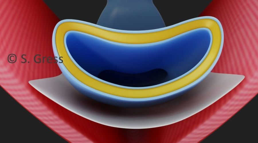 prinzip-der-vaginalstraffung-scheidenverengung