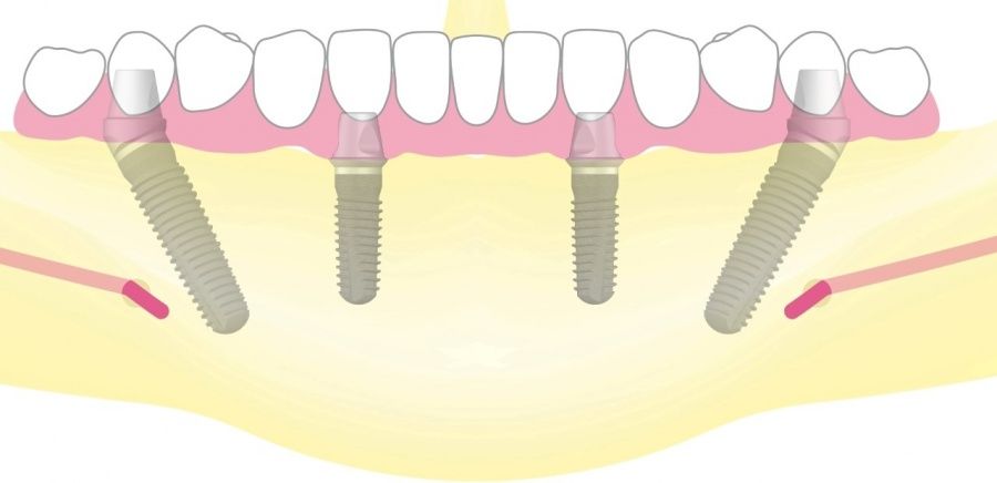 An einem Tag: Zahnimplantate und der darauf verankerte, feste Zahnersatz mit All-on-4