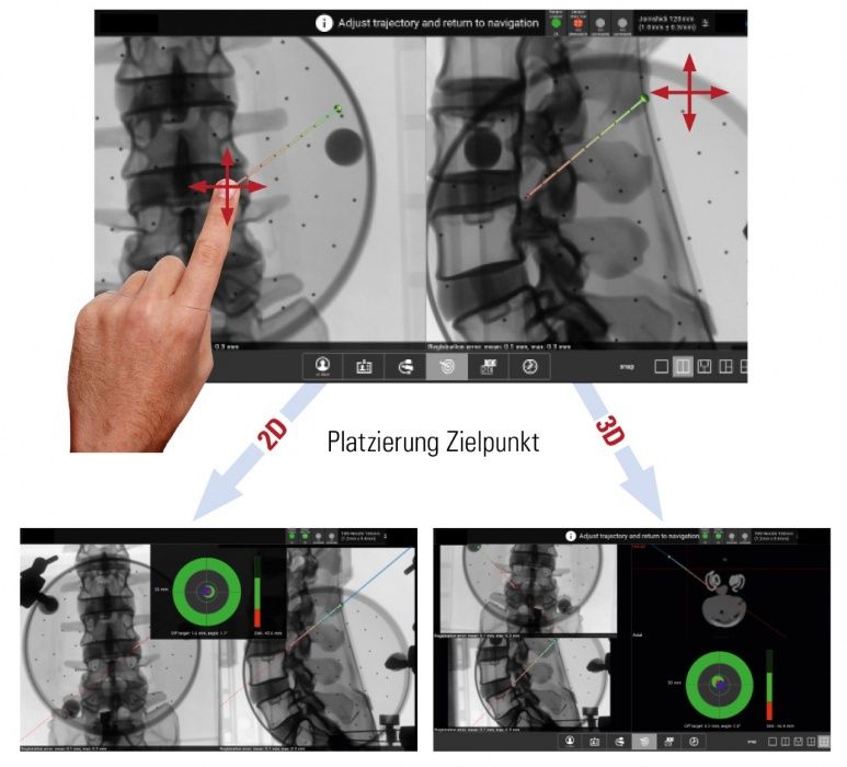 Endoskopische Bandscheibenoperation mit Navigationssystem