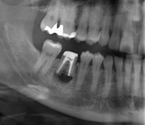 Wurzelspitzenresektion oder Zahnimplantat? Das sind die Vorteile